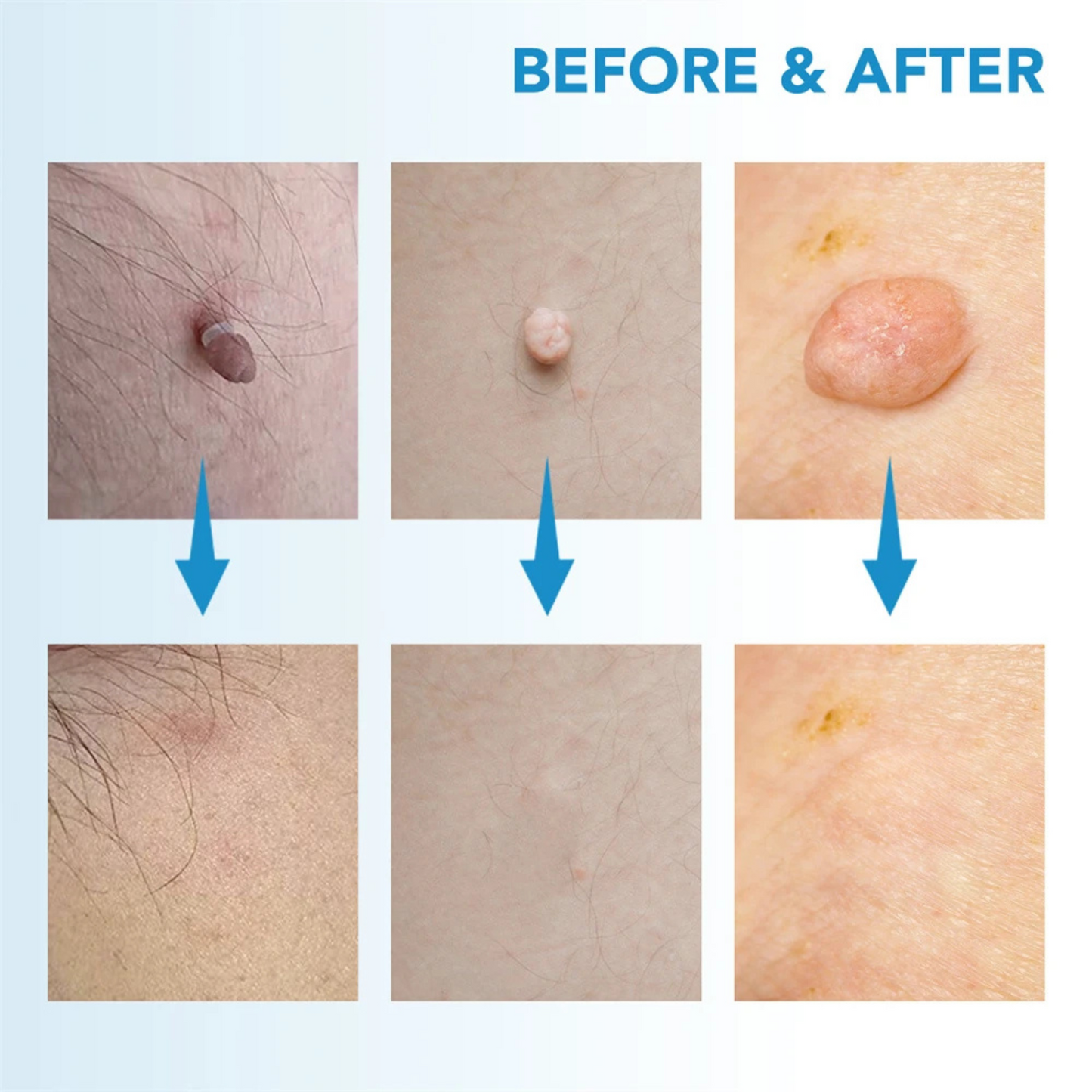 TagClear™ Kit - Get Rid of Skin Tags At-Home, Fast!