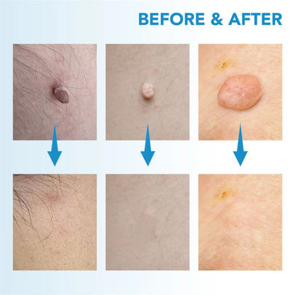 TagClear™ Kit - Get Rid of Skin Tags At-Home, Fast!